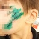 «Нос буквально висел»: в Кинешме 9-летнего мальчика растерзала собака