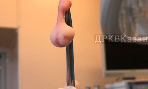 В Казани врачи помогли ребенку, который родился с двумя языками В Казани врачи помогли ребенку, который родился с двумя языками