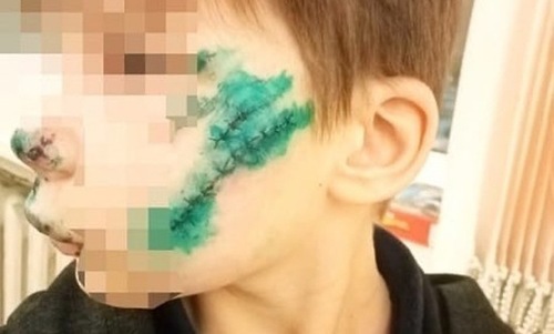 «Нос буквально висел»: в Кинешме 9-летнего мальчика растерзала собака